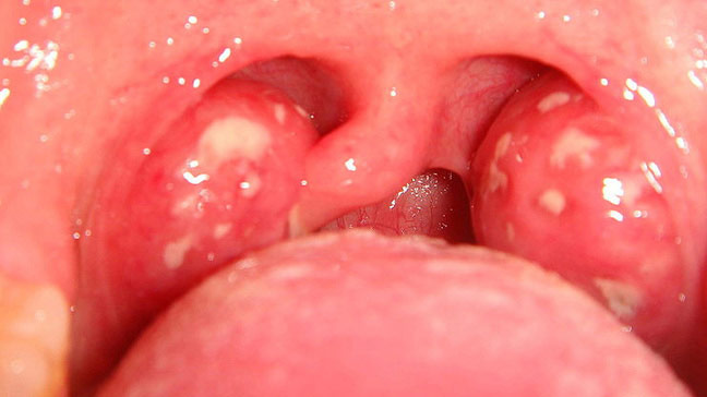 Babys Swollen Throat Virus 16