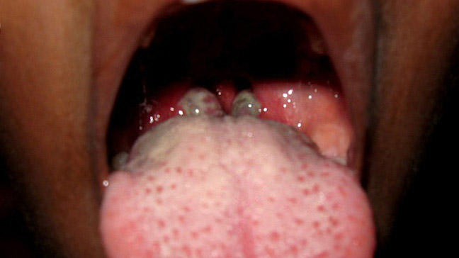 What is phlegm in the throat?