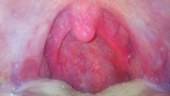 Virus Throat 113