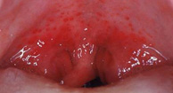 Red Spots In Throat 61