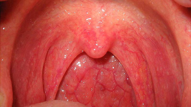 Strep Mouth 107