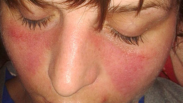 Lupus (Systemic Lupus Erythematosus)-Symptoms - WebMD