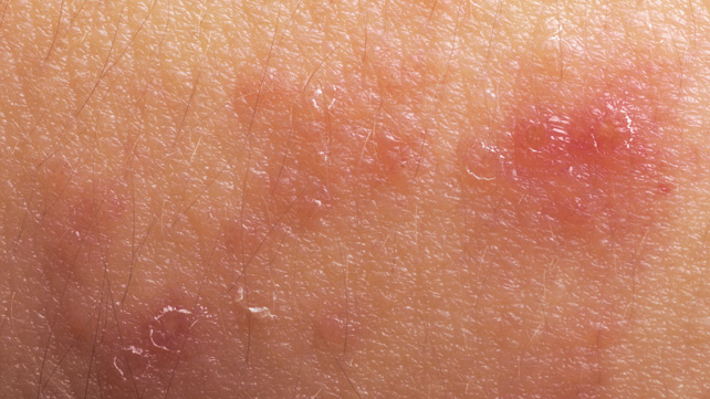 Psoriasis vs Eczema Pictures - Healthline