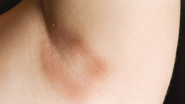 Red Itchy Skin Rashes: 7 Common Causes | SELF