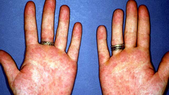 What are some common causes of rashes on hands and fingers?