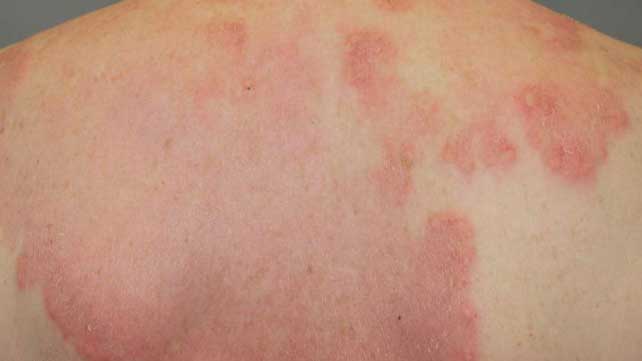 What is rheumatoid arthritis rash? - Edmonton First Aid