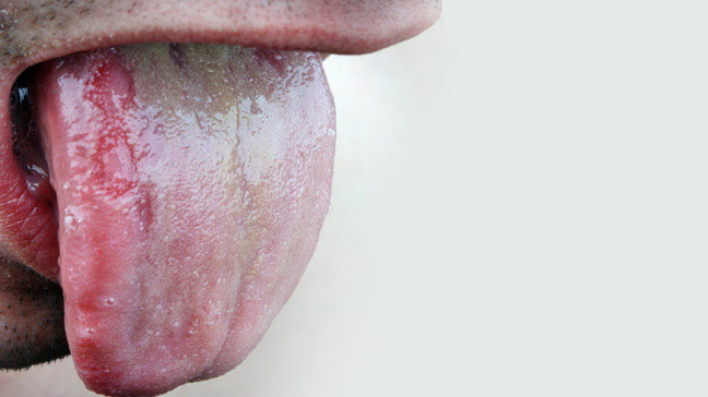 Is oral thrush contagious in adults?
