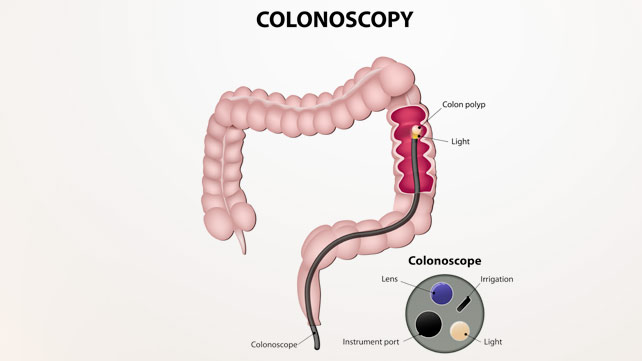What is the recommended frequency for a colonoscopies for a male over 40?