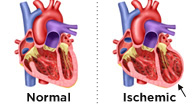 What is ischemic cardiomyopathy?