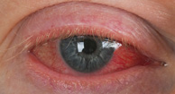 Eyelid - Wikipedia