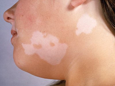 Little Boy Has Skin Problem Stockfoto 194169908 - Shutterstock