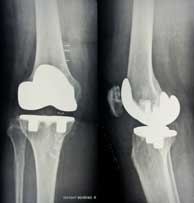 knee replacement x-ray