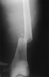 X-ray of a fractured femur bone