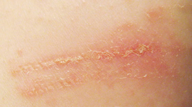 What are some symptoms of skin dermatitis?
