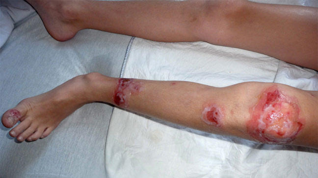 Impetigo - Dermnet: Dermatology Pictures - Skin Disease ...
