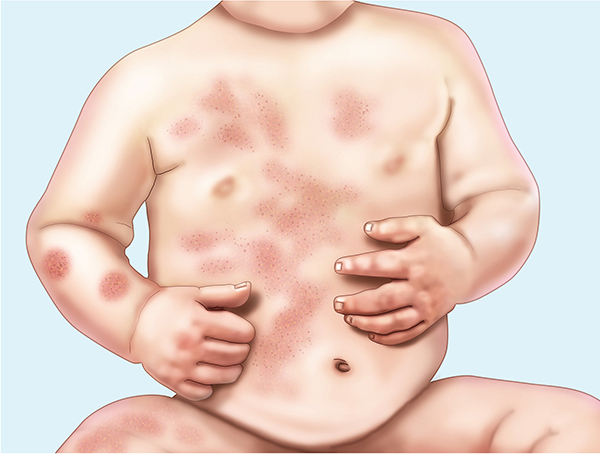 Eczema - the Web's most visited site about children's health