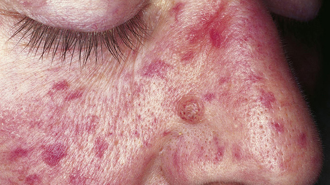 Systemic Lupus Erythematosus (SLE) Picture Lupus Rash