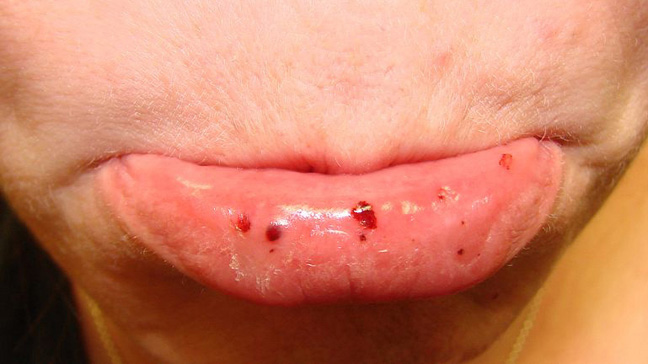 Red Dots Inside Mouth 38