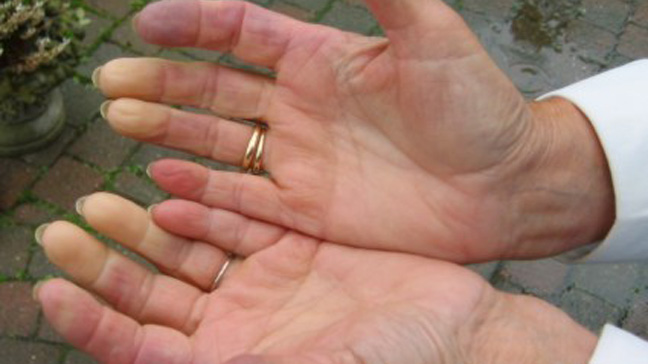 raynaud disease pictures hands #10