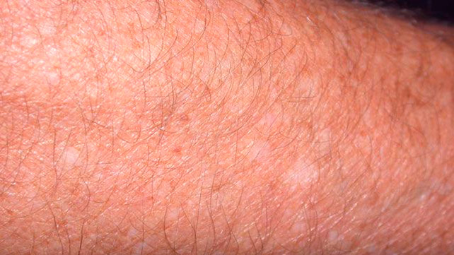 White Spots On Skin White Spots On Face Dots Patches Small