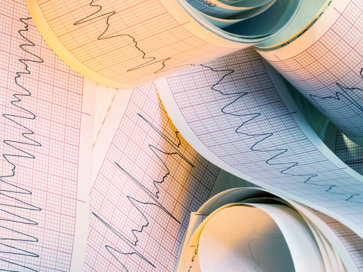 AFib with RVR: Diagnosis, Treatment, and More