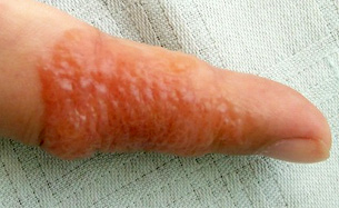 Elocon Eczema Treatment Information - Healthy-Skin-Guide.com