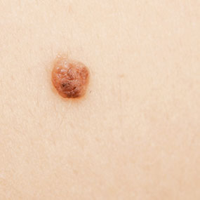 Nodular melanoma | DermNet New Zealand