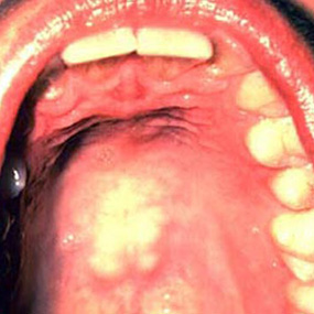 What could a lump or bump on the roof of your mouth be?