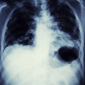 Small Patch Of Pneumonia