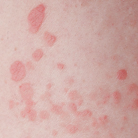 RED SPOTS ON MY CHEST. - Posts - medhelp.org