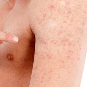 Where do you find pictures to help diagnose a rash on arms and shoulders?
