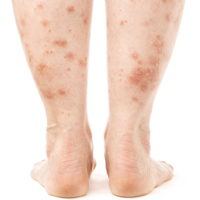 red blotches on lower legs #10