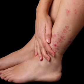 Itchy Rash on Top of Foot: Causes and Treatments | New ...