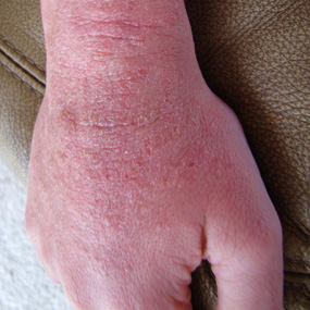 Hand dermatitis | DermNet New Zealand