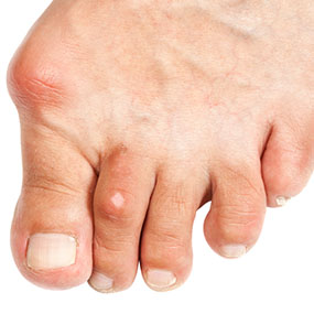 Gouty arthritis top of foot - diet chart for high uric ...
