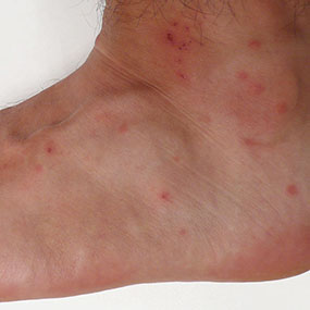 Red Itchy Bumps on Legs | Med-Health.net