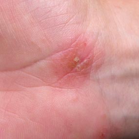 Patch Of Blisters On Skin