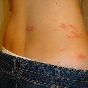 Does shingles occur in children?
