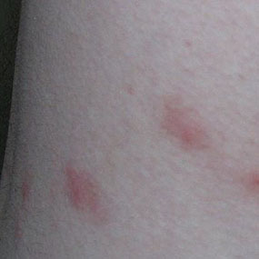 Flea Bites on Humans – Flea Bite Symptoms