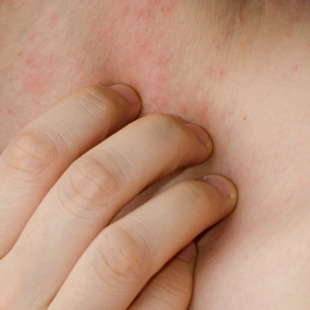 Is Your Rash Caused by Hepatitis C? - Healthline