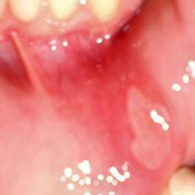 different types of mouth sores