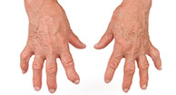 Is arthritis hereditary?