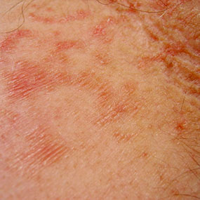 red itchy bumps on legs - WebMD Answers