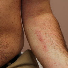 Can a leg rash become cancer?