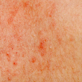 pinprick red dots, itchy skin, wrongly diagnosed - Our Health