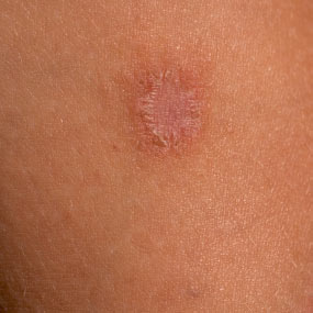 Small Round Dry Patch On Skin