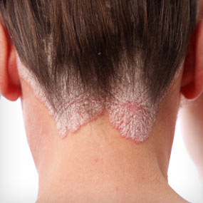 Large psoriasis scales on a person&amp;#039;s scalp