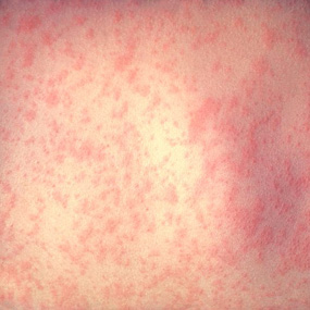 Measles (Rubeola) - MedicineNet