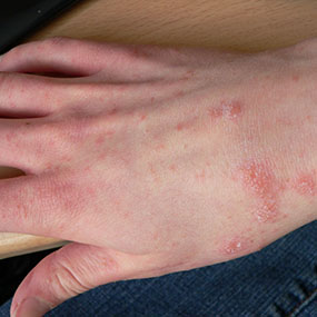 Are These Bed Bugs or Scabies? | Terminix