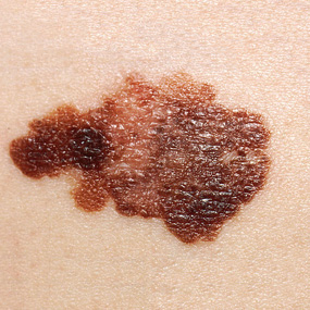 What medical websites show pictures of types of skin cancer?